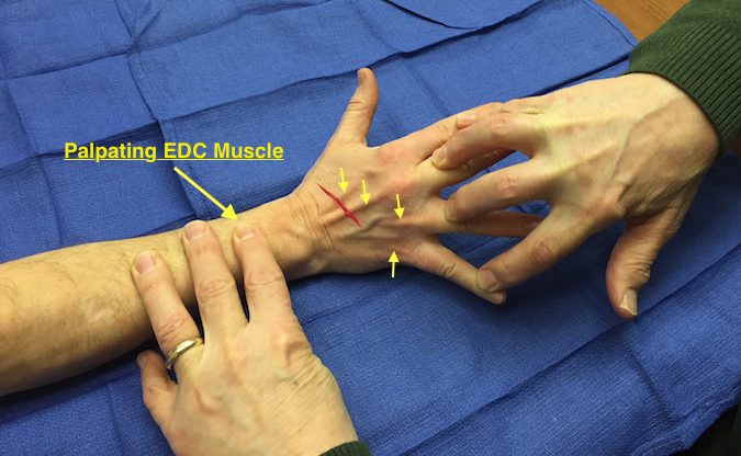 Extensor Digitorum Communis (EDC) Laceration