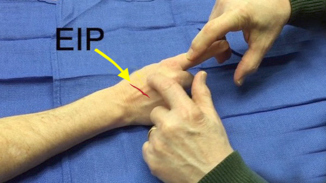 EIP exam of patient with laceration in dorsal section 9.
