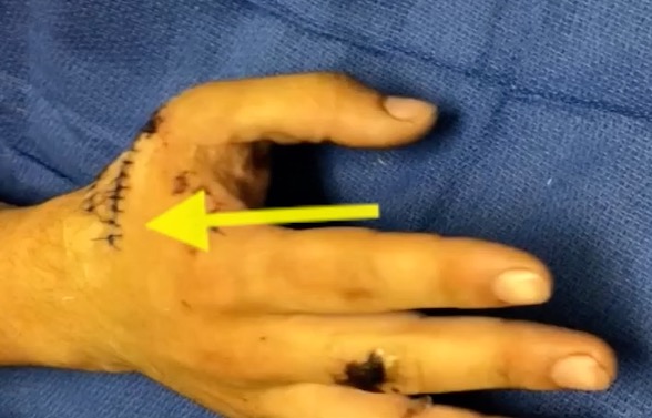 Dorsal thumb laceration at the base of the thumb metacarpal. Note flexed posture of the thumb MP and IP joints.