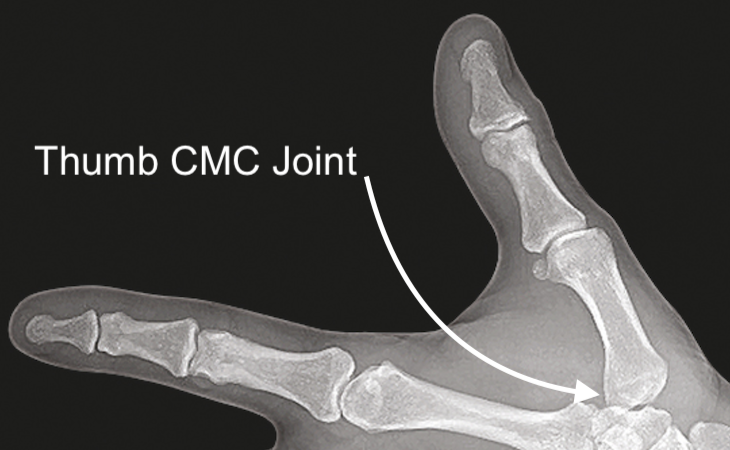 CMC joint X ray