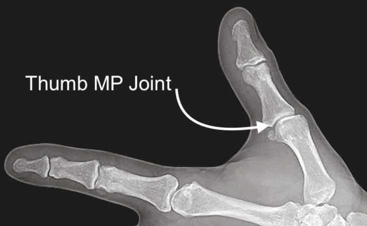 MP joint