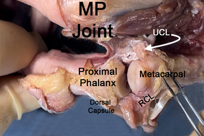 MP joint