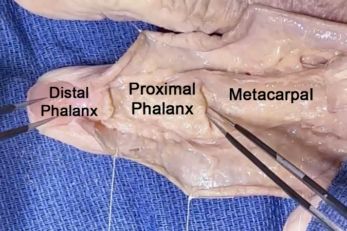  Thumb First Metacarpal Bone Anatomic View