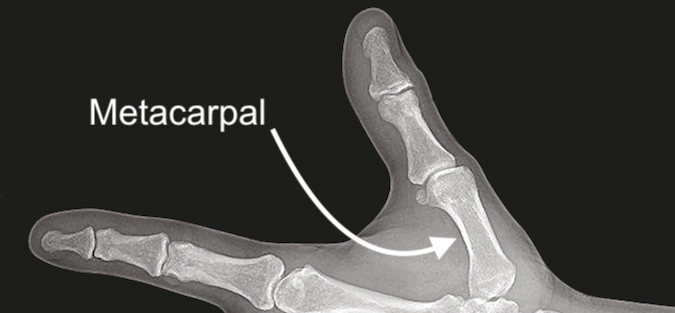  Thumb Metacarpal Bone X-ray View