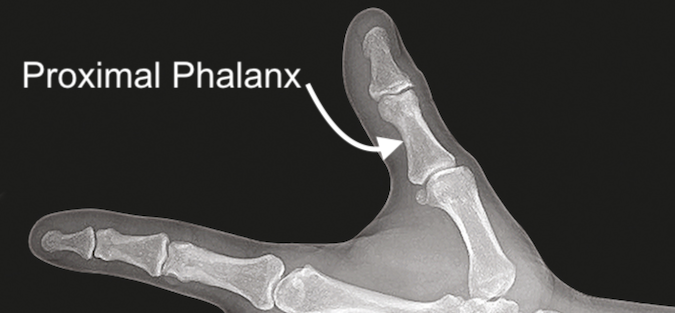  Thumb Proximal Phalanx Bone X-ray View