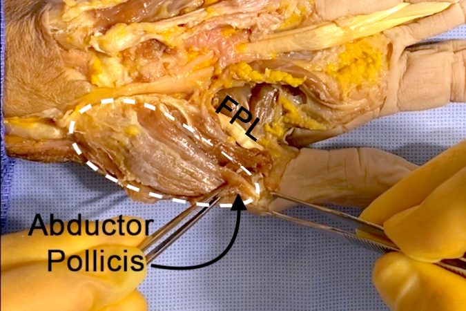 Abductor Pollicis Brevis (APB)