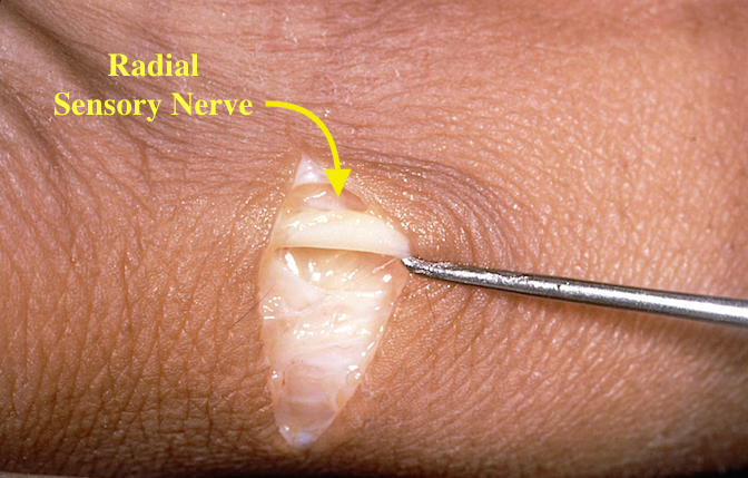 Dorsal Radial Sensory (Superficial Radial) Nerve