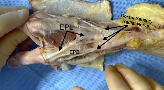 Dorsal Radial Sensory (Superficial Radial) Nerve