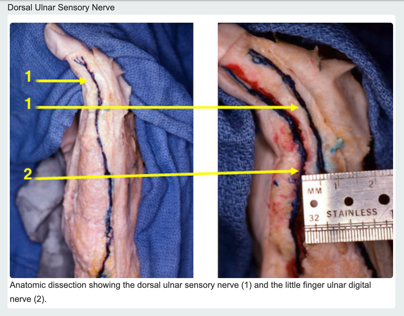 Dorsal Sensory Ulnar Nerve & Fifth Ulnar Digital Nerve