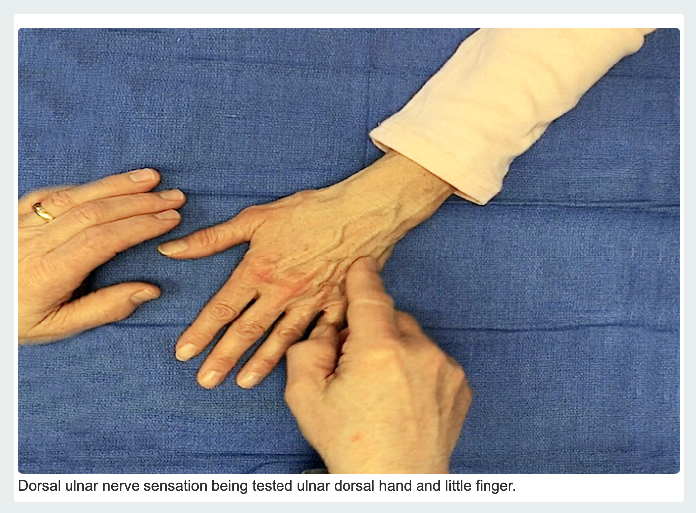 Dorsal Ulnar Sensory Nerve sensory testing.