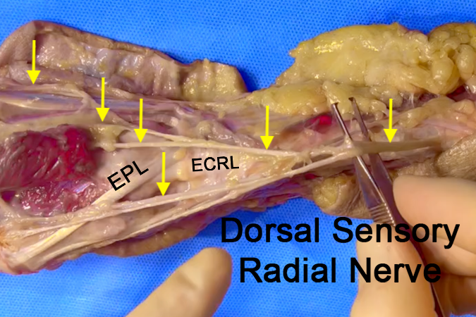 Dorsal Radial Sensory (Superficial Radial) Nerve (arrows)