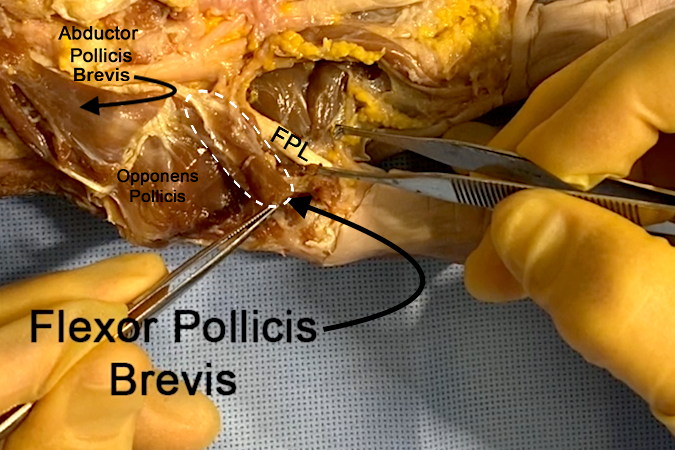 Flexor Pollicis Brevis (FPB)