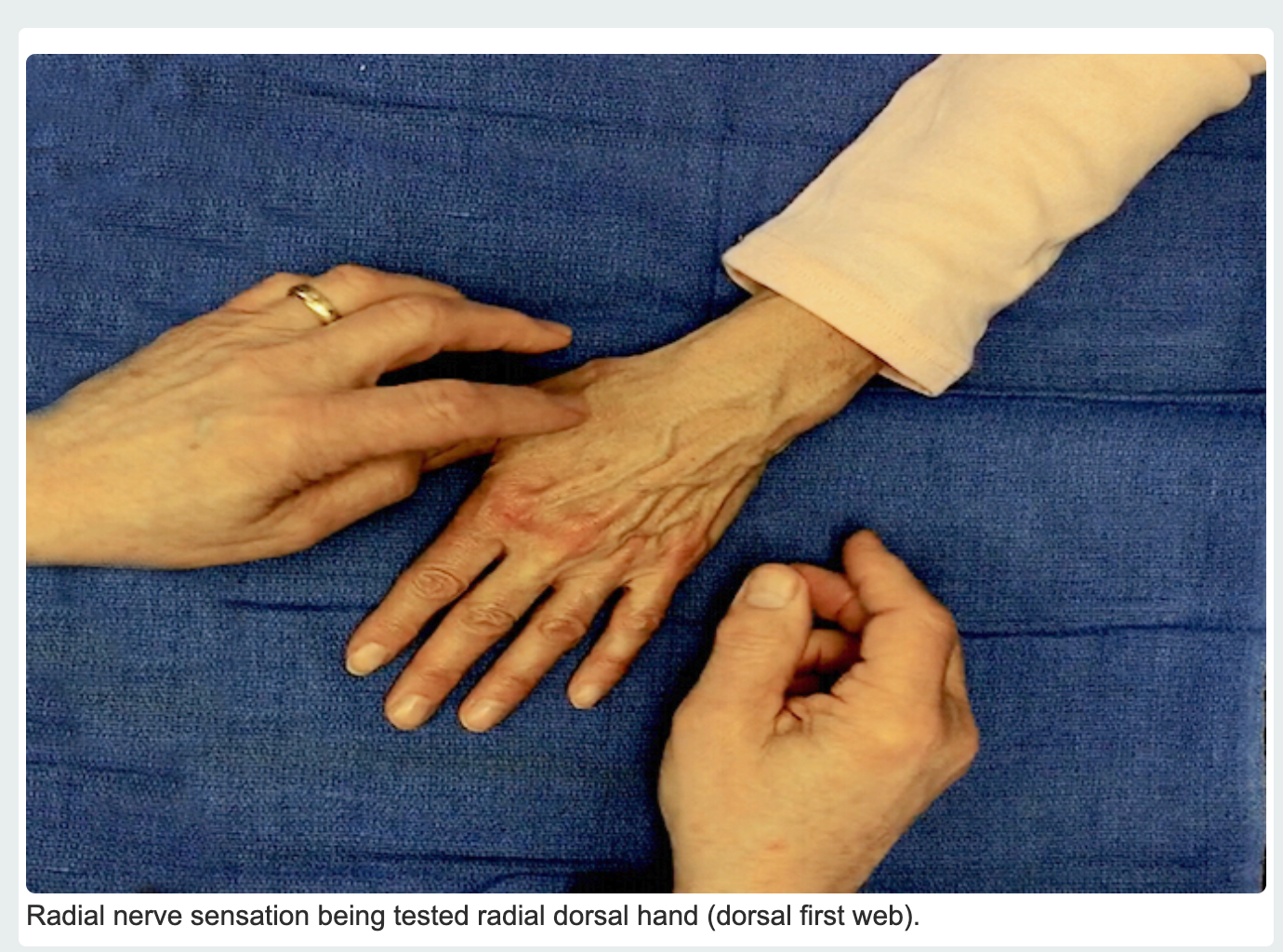 Dorsal Radial Sensory (Superficial Radial)  Nerve sensory testing.