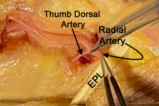 First web view showing thumb dorsal artery, radial artery, and EPL tendon.