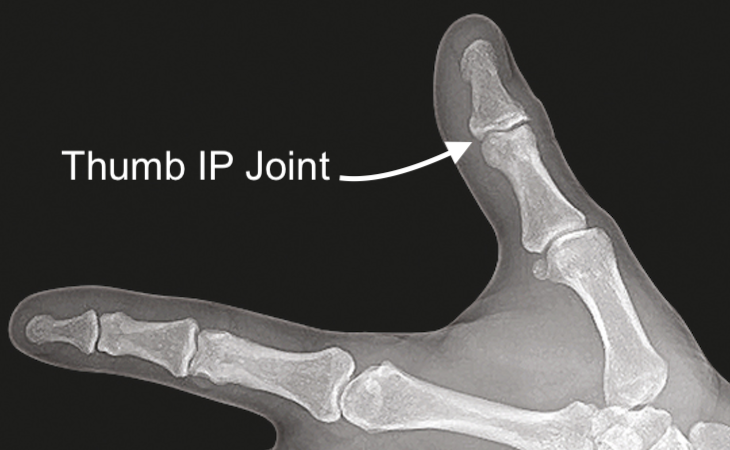 Thumb IP Joint X-ray view