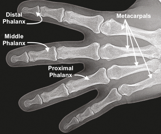 Normal X-ray Image of distal phalanx, middle phalanx, proximal phalanx, and metacarpals. Normal X-ray Image of distal phalanx, middle phalanx, proximal phalanx, and metacarpals.