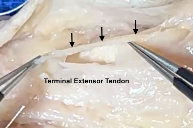 Branch of the digital nerve coming off the trifurcation of the digital nerve at DIP joint level.