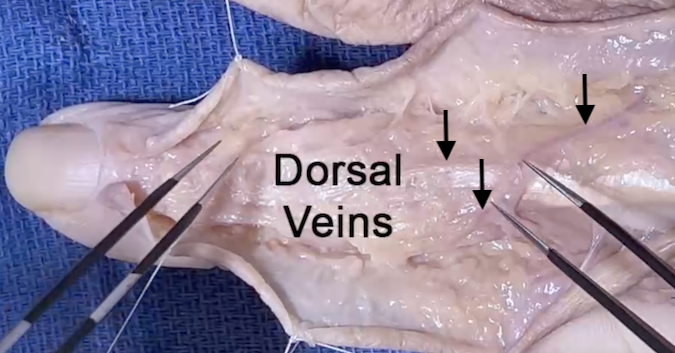 Dorsal Digital Veins (arrows)