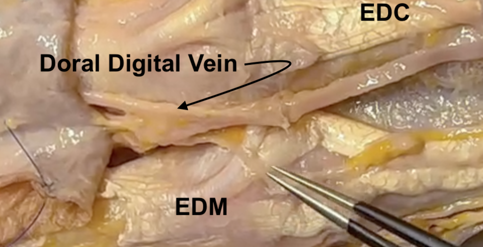 Dorsal Digital Vein (arrow)