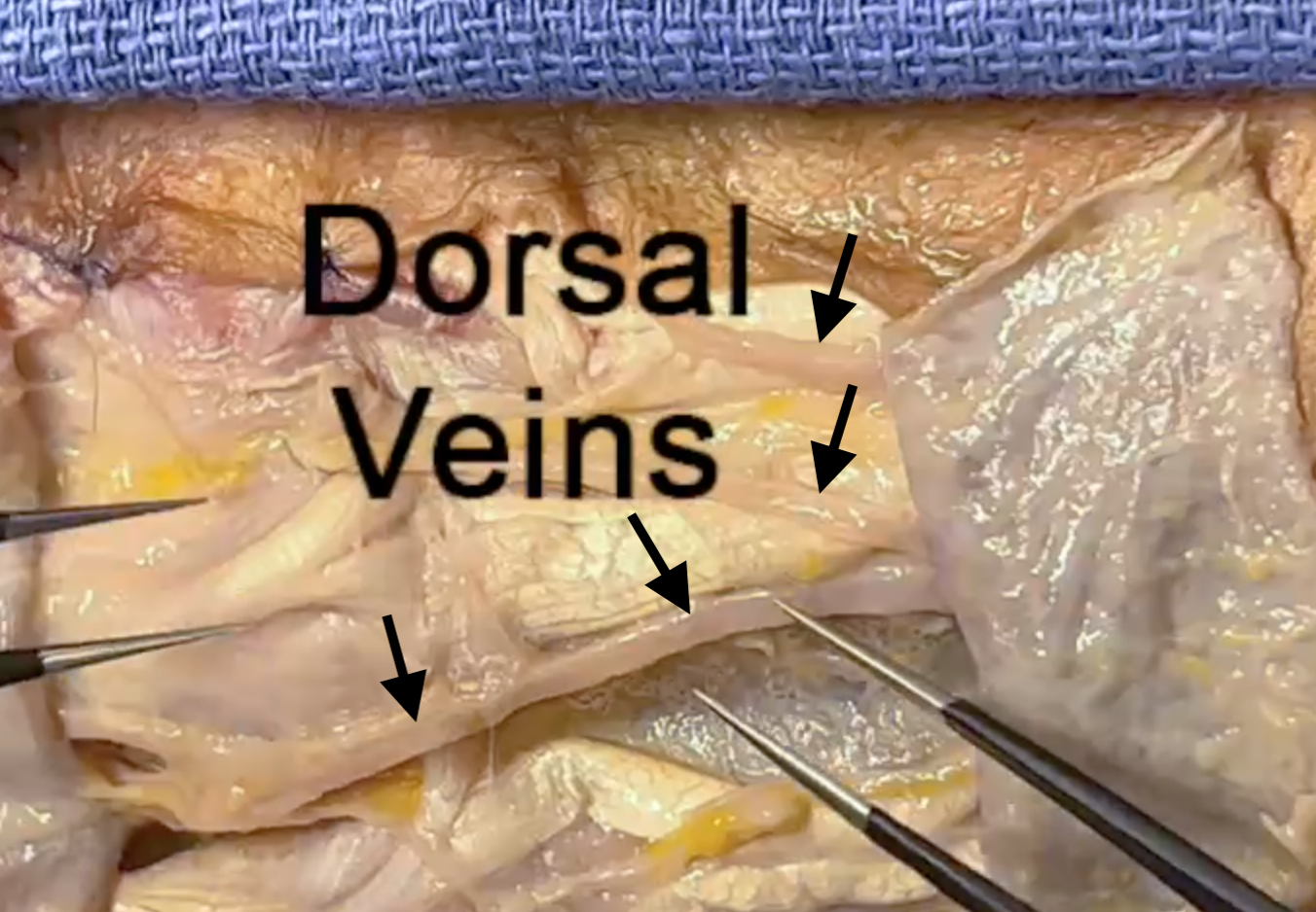 Dorsal Hand Veins at the distal 4th and 5th metacarpal level.