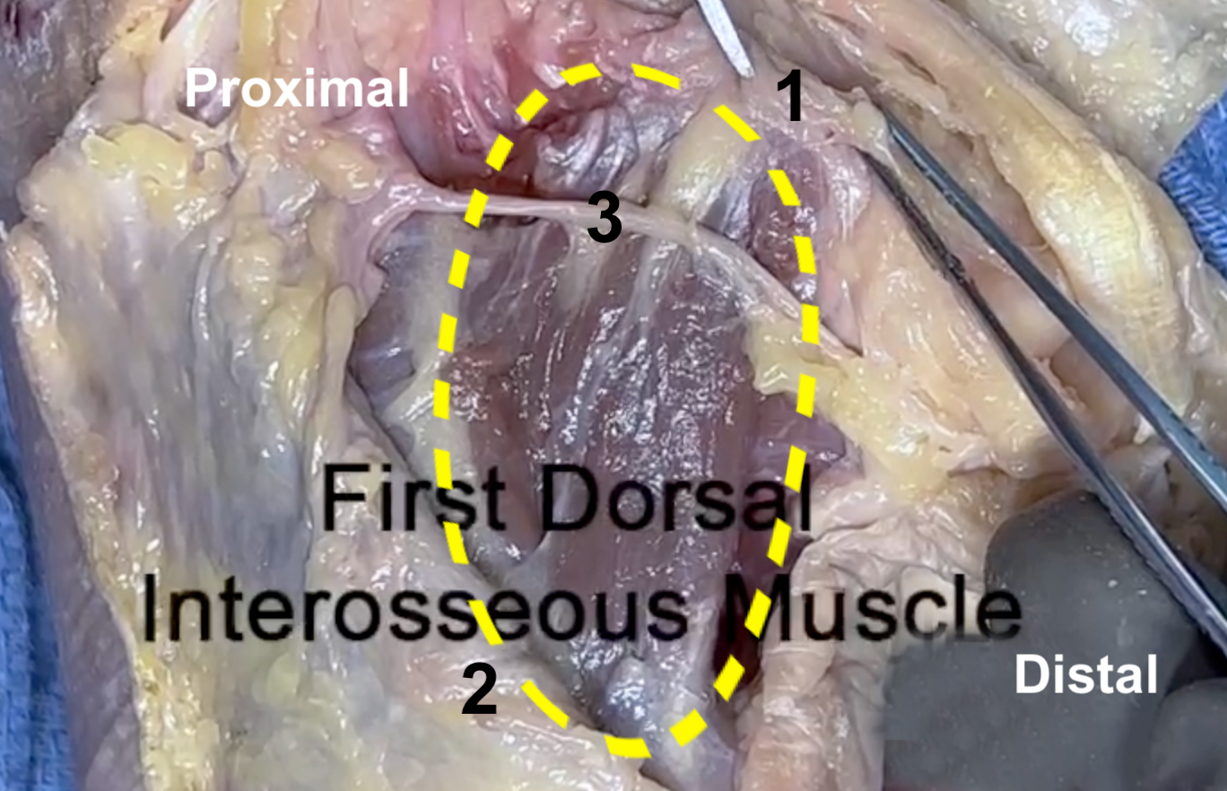 First dorsal interosseous muscle between thumb metacarpal (1) and second metacarpal (2). Note distal web and proximal end of first web. Dorsal radial sensory nerve (3) is crossing the muscle. 