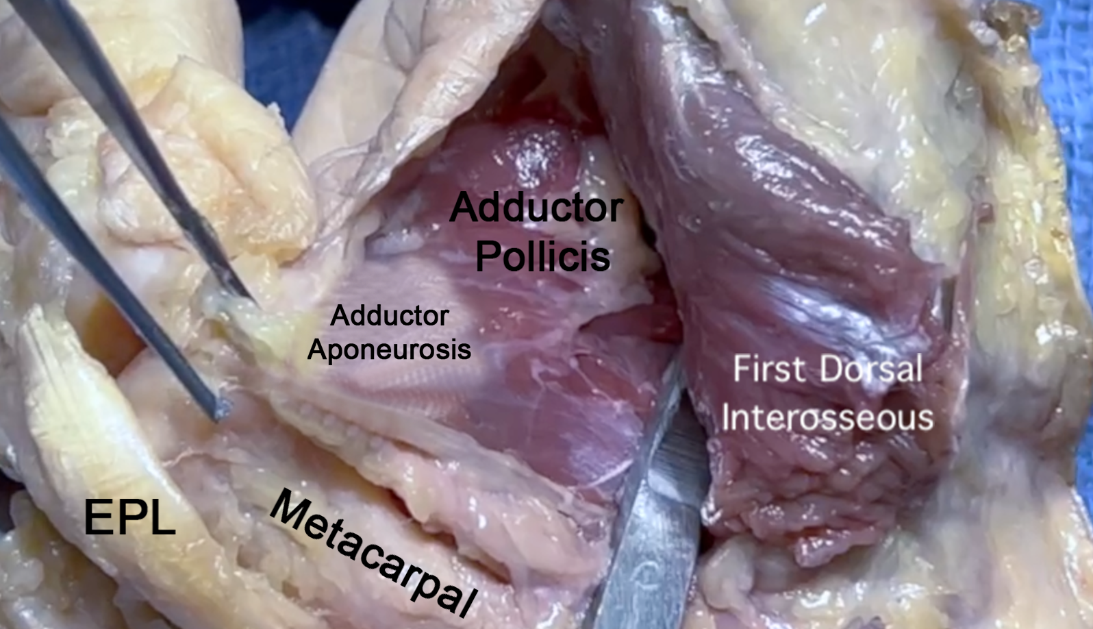 First dorsal interosseous muscle has been cut off the first metacarpal to expose the adductor aponeurosis and adductor muscle. Extensor pollicis longus (EPL) noted.