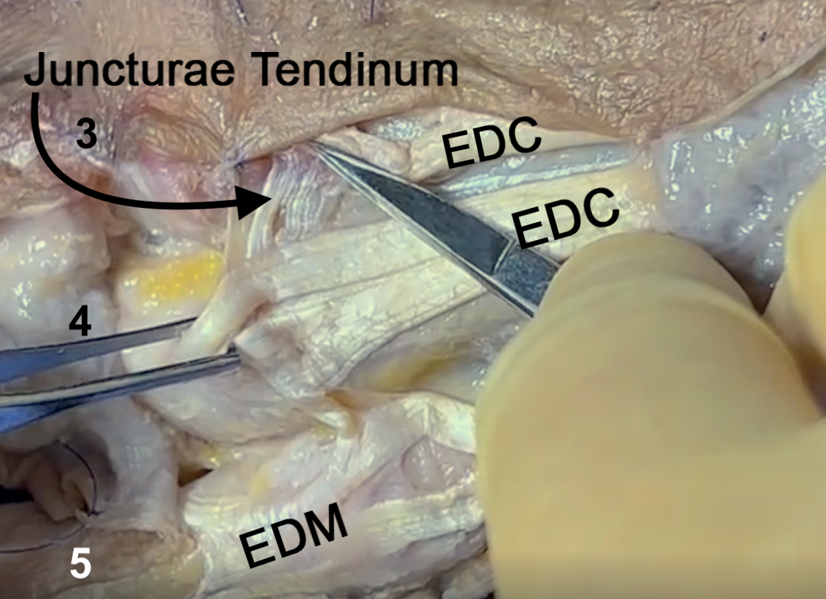 Juncturae Tendinum, Type II,  between long (3) and ring (4)EDC tendons. 
