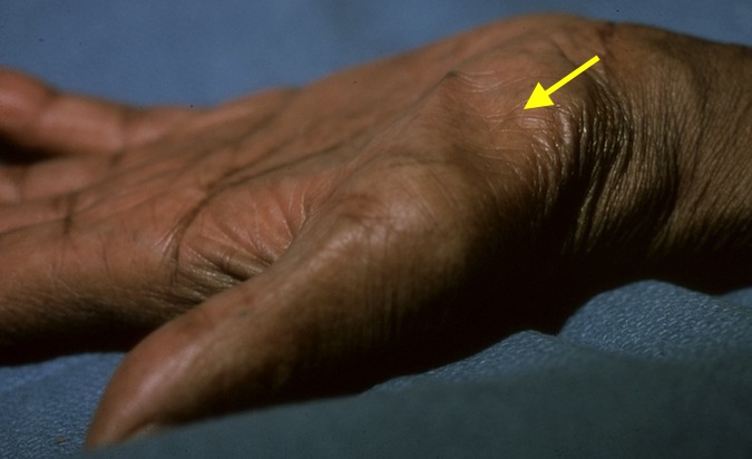 Observation can identify atrophy (arrow) of the thenar muscles (APB, FPB, and OP).