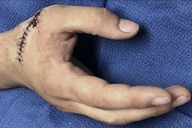 Thumb with lacerated EPL, EPB, and APL. Note lack of thumb abduction, thumb MP extension, and thumb IP extension.