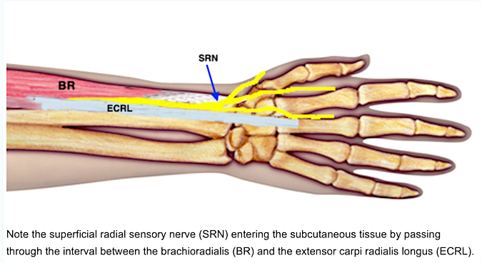 Wartenberg's Syndrome