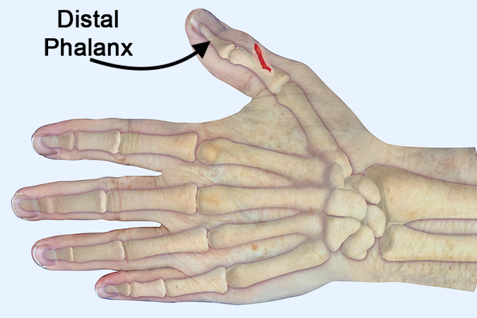 Note distal phalanx in relationship to thumb soft tissues and thumb laceration.