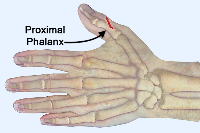 Note proximal phalanx in relationship to thumb soft tissues and thumb laceration.  Palpate side or volar surface of bone to avoid pressure on laceration.