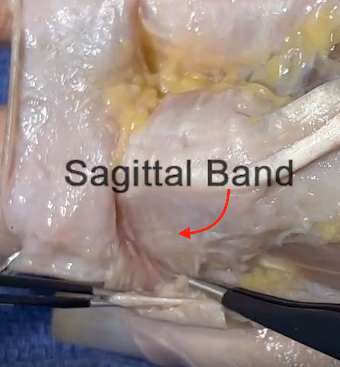 Sagittal Band