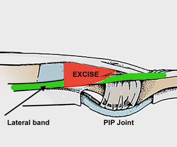 The red area is excised during a intrinsic release for intrinsic tightness.