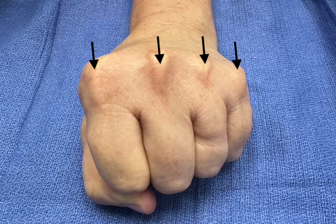 Normal fisted hand with centralized extensor tendons (arrows) secondary to intact radial and ulnar sagittal bands.