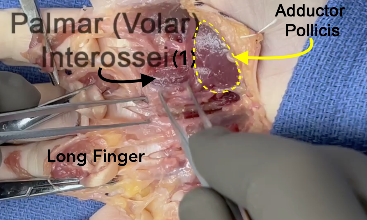Note the first palmar interosseous muscle on the ulnar side of the index metacarpal bone.