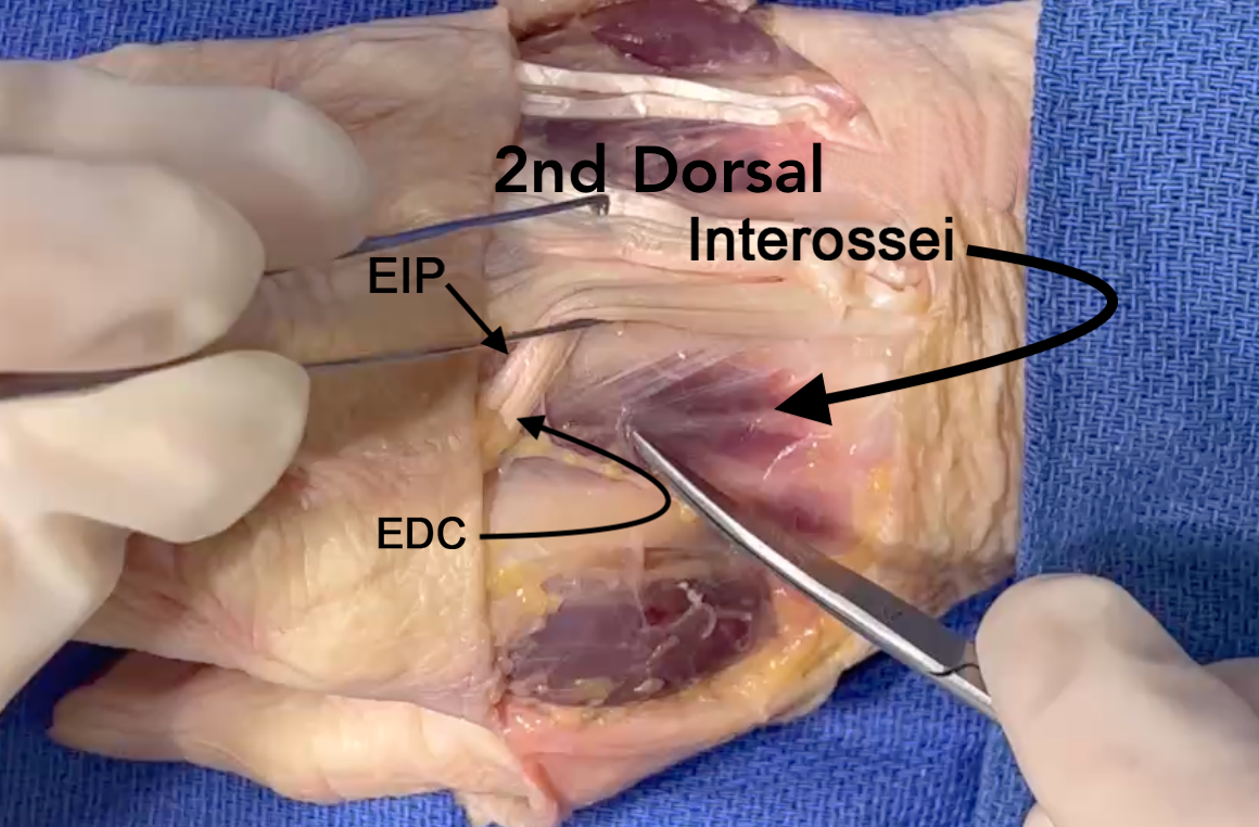 2nd dorsal interosseous muscle 