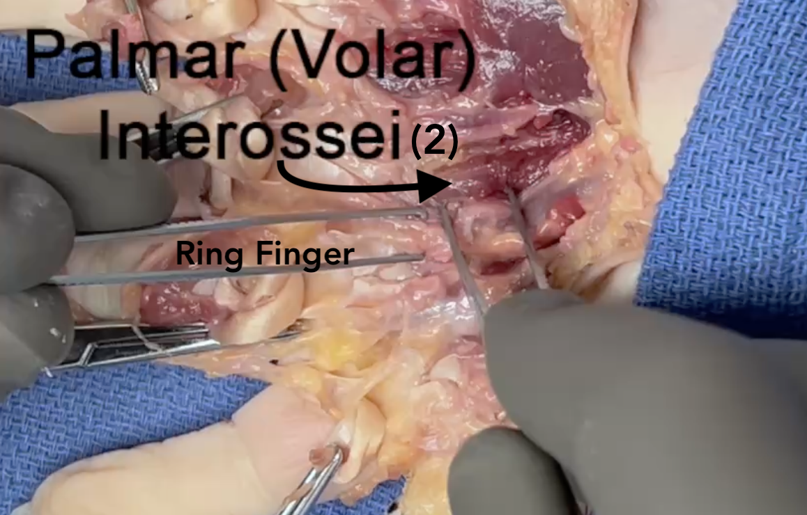 The second palmar interosseous muscle
