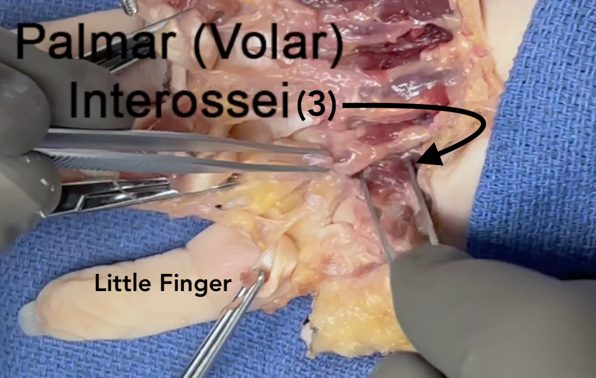  The palmar third interosseous muscles
