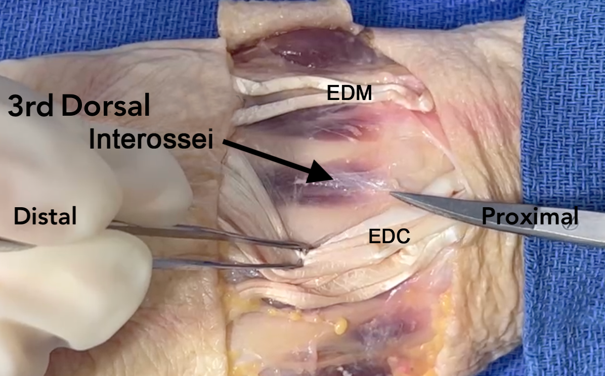 Third Dorsal Interosseous Muscle (arrow)