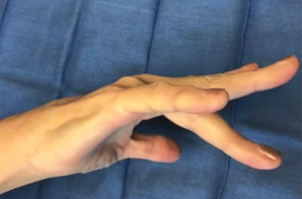 Incomplete long finger active extension secondary to ruptures sagittal band.