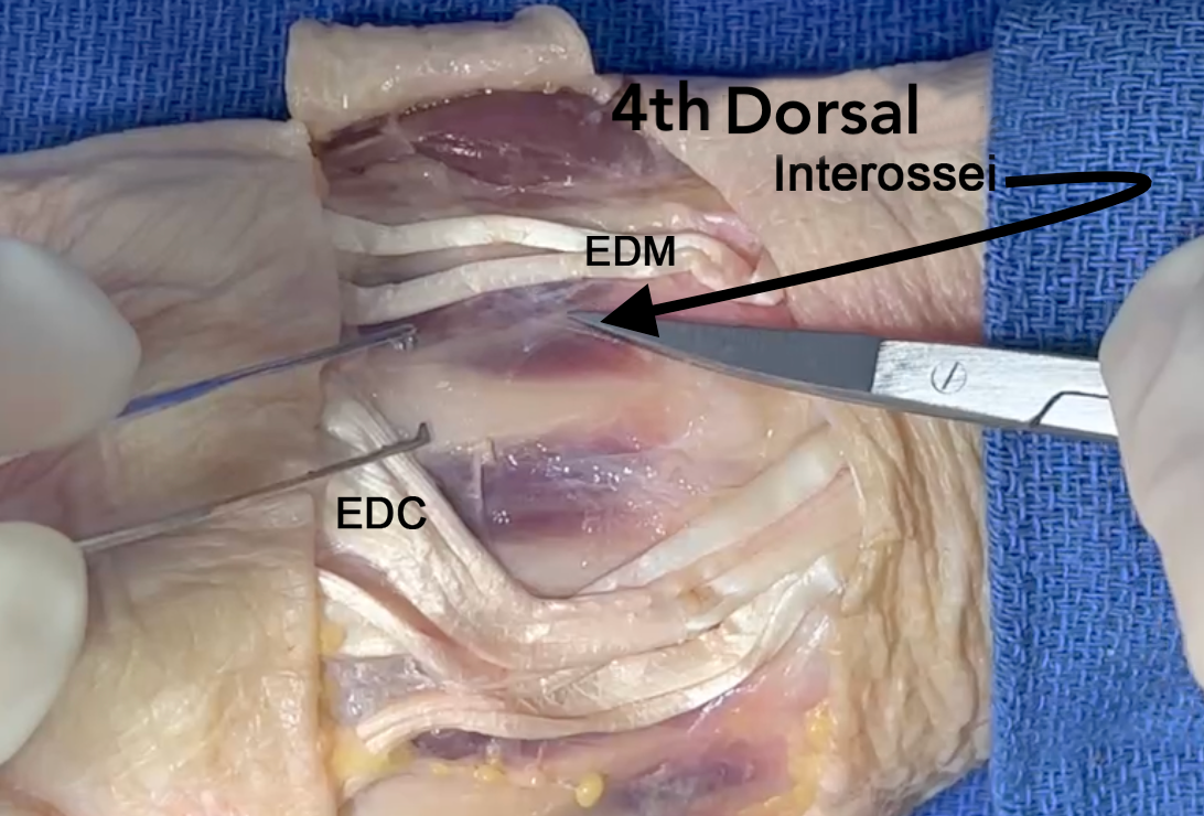 The fourth dorsal interosseous muscle
