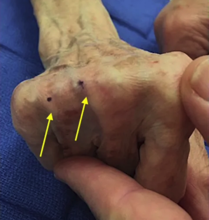 Note the central location of the extrinsic extensors (arrows) in the fisted hand with normal sagittal bands.