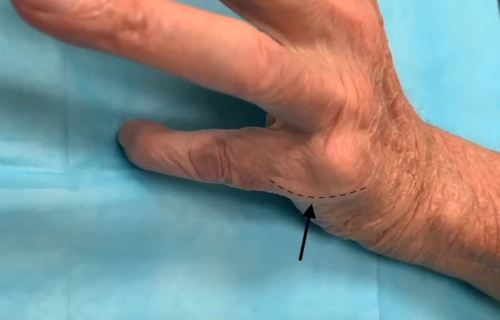 Fifth MP joint locked in flexion secondary to ruptured radial sagittal band and ulnarly subluxated extensor tendons.