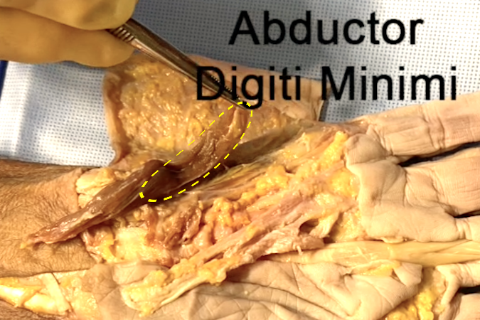Abductor digiti minimi (yellow ellipse) released from its distal insertion and mobilized on its origin at he pisiform.
