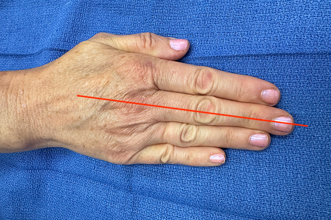 The palmar interosseous muscles adduct the fingers towards the central long finger ray (red line).