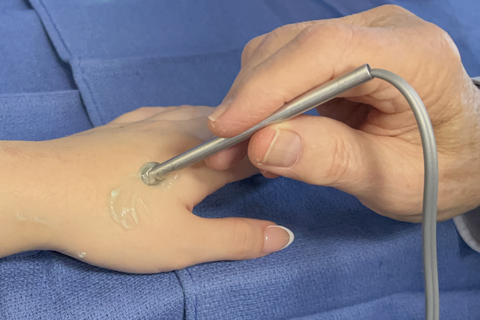 Doppler probe being used to assess the dorsal radial artery and the arterial branches to the dorsal thumb and index metacarpal area.