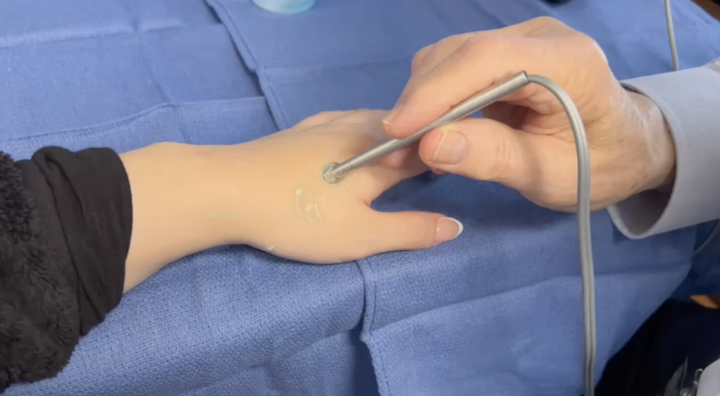 Doppler exam of the first dorsal metacarpal artery.