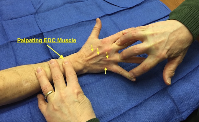 EDC muscle testing. Note the EDC tendon slips (arrows). Note the examiner is palpating the EDC muscle belly to evaluate the muscle bulk and contraction.