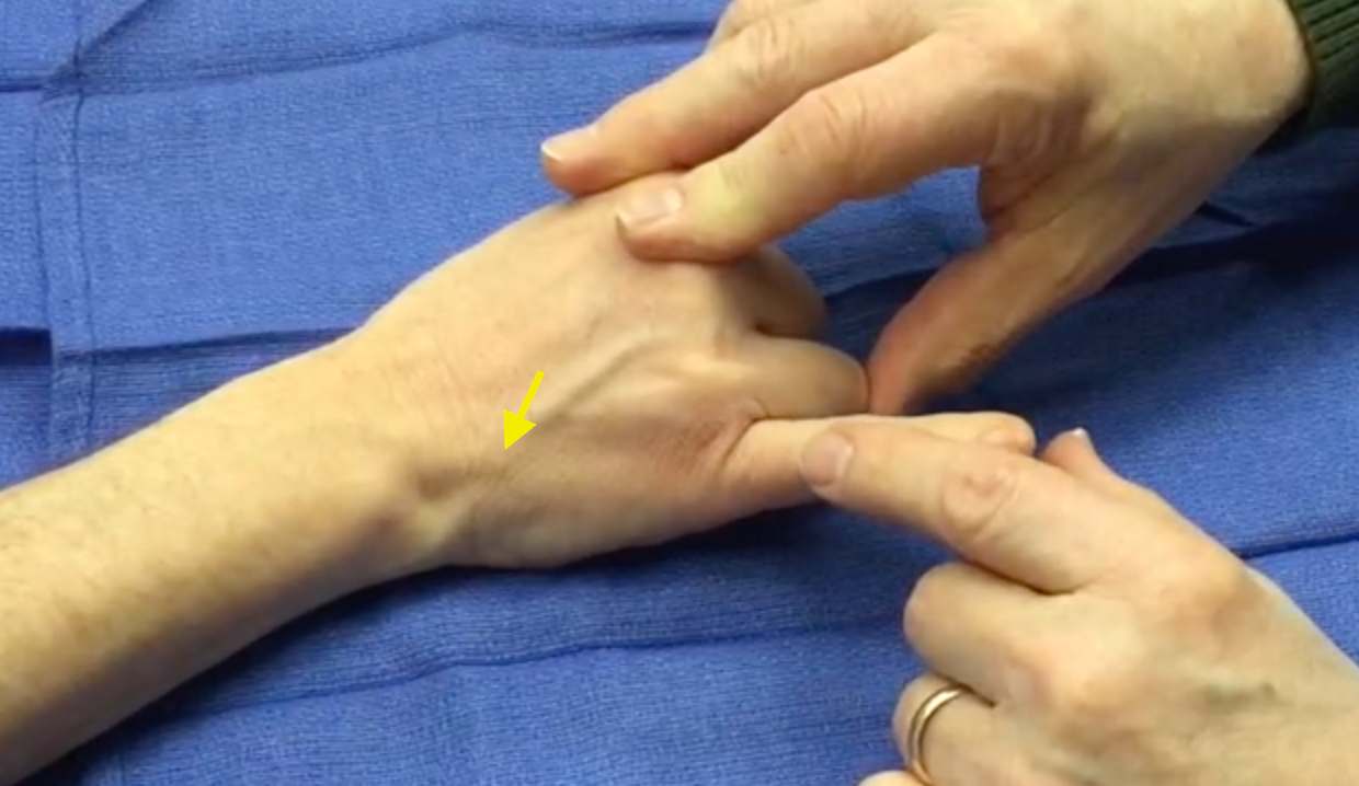 EDM Muscle Testing. Note the index, long, and ring are held in flexion.